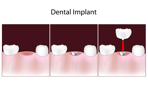 Dental Implants in East Brunswick