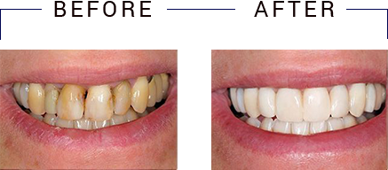 The image shows a side-by-side comparison of a person s teeth before and after dental treatment, highlighting the improvement in oral hygiene.