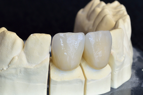Ceramic Dental Crowns in East Brunswick