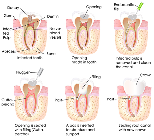 Root Canal 